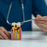 Root Canal Model