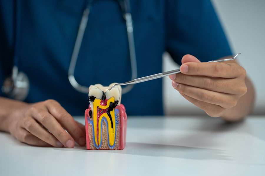 Root Canal Model
