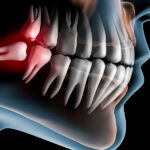 Illustration of Wisdom tooth that needs removed