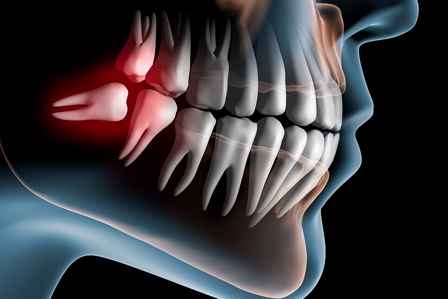 Illustration of Wisdom tooth that needs removed